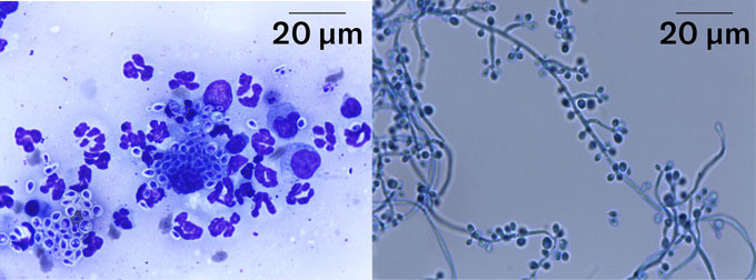 Un champignon mortel qui peut infecter les chats et les humains se propage Deux images au microscope du champignon Sporothrix brasiliensis. Sur la gauche se trouve une image de cellules humaines et de la forme levure du champignon, toutes deux colorées en bleu/violet. Sur la droite se trouve une image de la forme hyphale qui ressemble à une longue corde sur laquelle poussent de petites sphères ressemblant à des raisins.