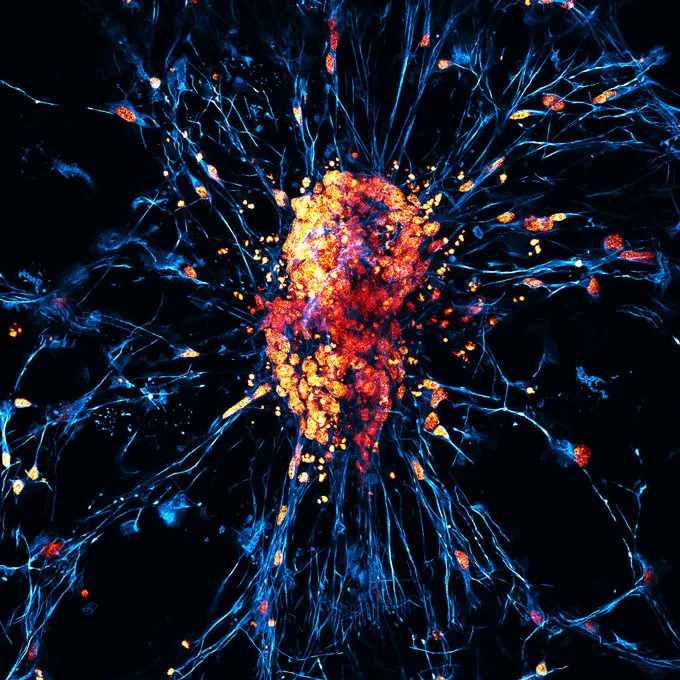 Des amas lumineux de noyaux cellulaires parsèment un réseau ramifié de neurones humains issus de cellules souches reprogrammées.
