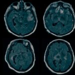 Des scientifiques de Colombie découvrent la source de la conscience cachée chez les patients « comateux » Source of Hidden Consciousness
