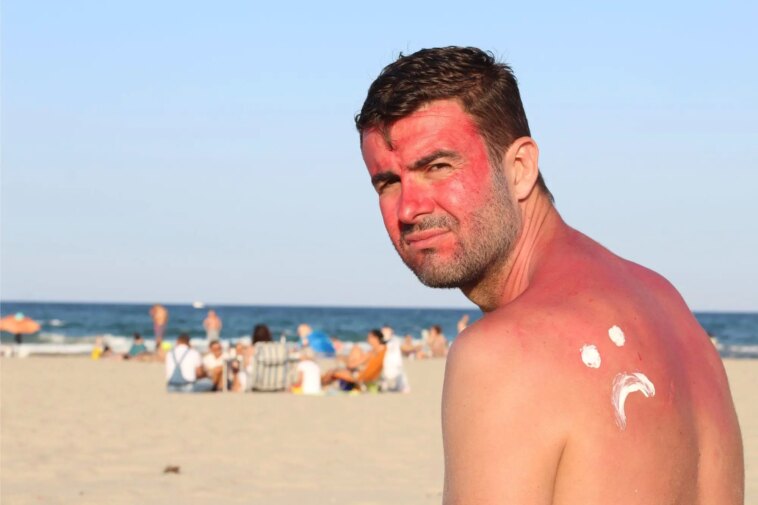 Sad SunBurned Man