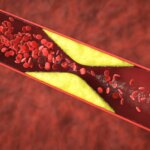 Agression cachée du cœur : le COVID-19 infecte les artères coronaires et augmente l’inflammation des plaques Atherosclerosis Plaque Vessel