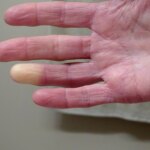 Cold Case résolu : le mystère de Raynaud résolu grâce à de nouvelles découvertes génétiques