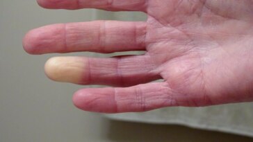 Cold Case résolu : le mystère de Raynaud résolu grâce à de nouvelles découvertes génétiques