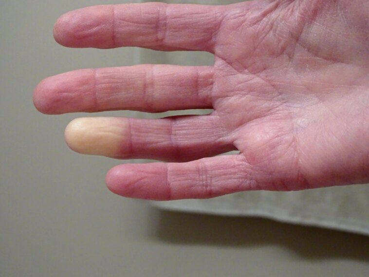 Cold Case résolu : le mystère de Raynaud résolu grâce à de nouvelles découvertes génétiques Cold Case résolu : le mystère de Raynaud résolu grâce à de nouvelles découvertes génétiques