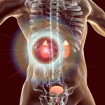 La mystérieuse épidémie rénale : les scientifiques découvrent une source potentielle surprenante Kidney Disease