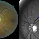 Les yeux ne mentent pas : découvrir de longs secrets du COVID grâce aux vaisseaux sanguins de l'œil