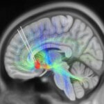 DBS Leads Implanted Into Subcallosal Cingulate Cortex