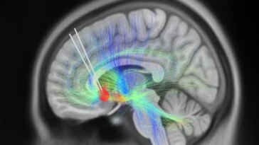 DBS Leads Implanted Into Subcallosal Cingulate Cortex