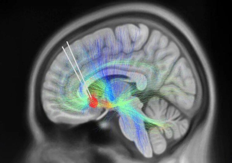 DBS Leads Implanted Into Subcallosal Cingulate Cortex