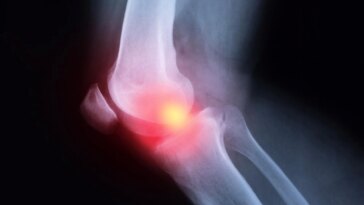 Arthritis Knee Pain X-ray Illustration