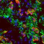 Le casse-tête pancréatique : percer le code des secrets immunitaires du cancer Pancreatic Cancer Cells CSHL