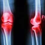 Osteoarthritis Knee Inflammation