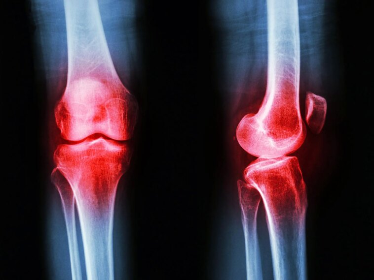 Osteoarthritis Knee Inflammation