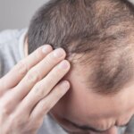 Percée en matière de calvitie – Les scientifiques découvrent 5 gènes clés Balding Hair Loss Man