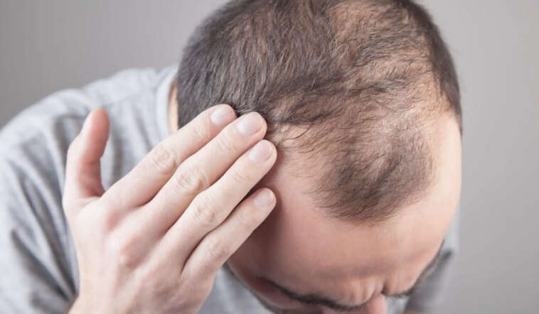 Balding Hair Loss Man