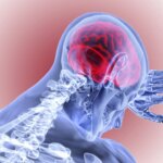 Brain Bleeding Stroke Hemorrhage