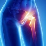 De petits changements, de grands avantages : de simples changements de mode de vie sont essentiels pour prévenir les fractures de la hanche Hip Pain Hip Fracture