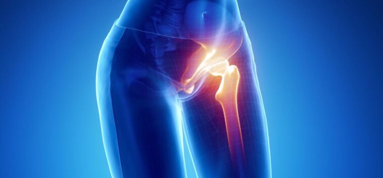 De petits changements, de grands avantages : de simples changements de mode de vie sont essentiels pour prévenir les fractures de la hanche Hip Pain Hip Fracture