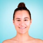 Percée biotechnologique : des bactéries cutanées intelligentes conçues pour traiter l'acné SciTechDaily