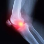 Percée dans le traitement de l'arthrite : les inhibiteurs de JAK se révèlent très efficaces dans une étude japonaise SciTechDaily