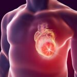 Concernant les résultats – Cette maladie cardiaque grave devient beaucoup plus courante SciTechDaily