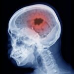 Une nouvelle recherche relie les médicaments hormonaux populaires aux tumeurs cérébrales SciTechDaily