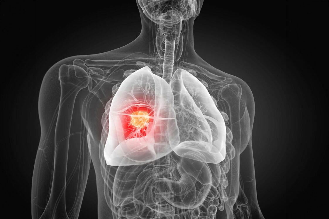 Mystère de mutation résolu : pourquoi les traitements contre le cancer