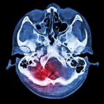 Nouvelle étude : la luminothérapie améliore la connectivité cérébrale après une blessure SciTechDaily