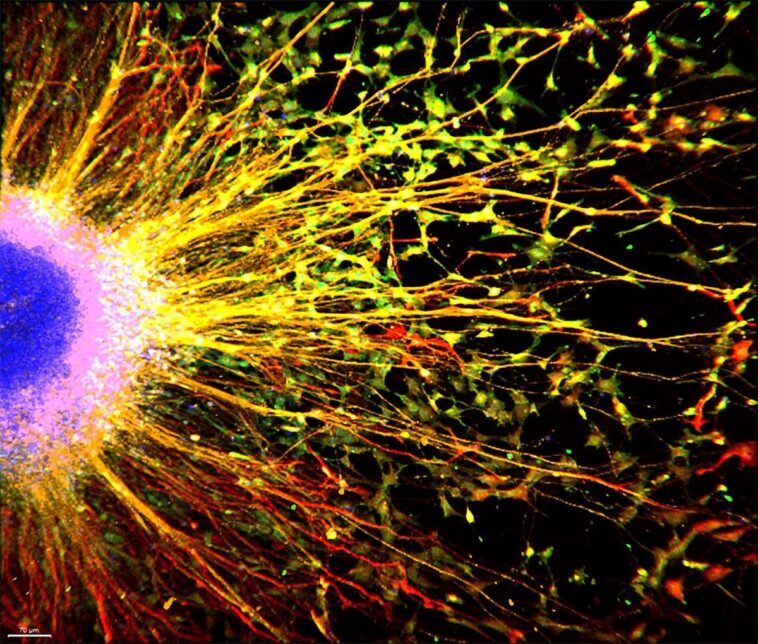 Un médicament expérimental contre le cancer offre de l'espoir pour le syndrome de Rett et les troubles cognitifs liés à l'autisme SciTechDaily
