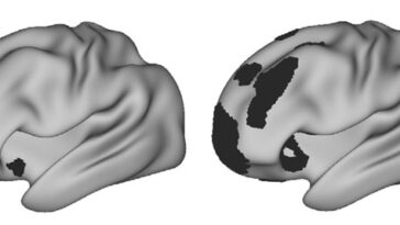 Deux cerveaux sont représentés en gris de profil. Celui de gauche présente des taches noires dans quelques zones, tandis que celui de droite présente de plus grandes taches noires dans des régions similaires