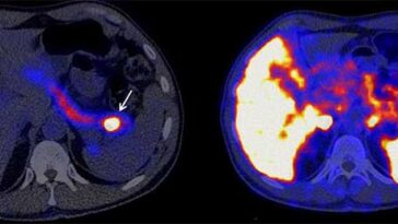 TEP avec et sans protéine de lézard pour détecter l'insulinome