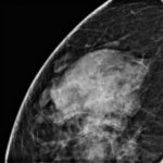 Mammographie d'un sein présentant un carcinome à tissus denses et canalaire in situ, également appelé cancer du sein de stade 0. Le CCIS apparaît sous la forme de petites taches blanches.