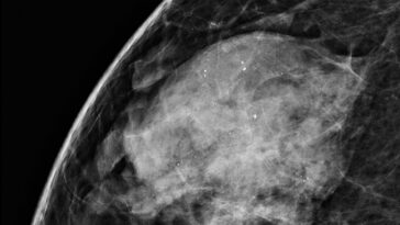 Mammographie d'un sein présentant un carcinome à tissus denses et canalaire in situ, également appelé cancer du sein de stade 0. Le CCIS apparaît sous la forme de petites taches blanches.