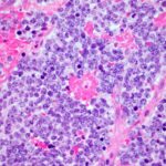 Les cellules en T voiture permettent une rémission record de cancer du nerf de 18 ans