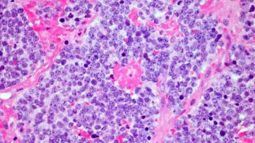 Les cellules en T voiture permettent une rémission record de cancer du nerf de 18 ans