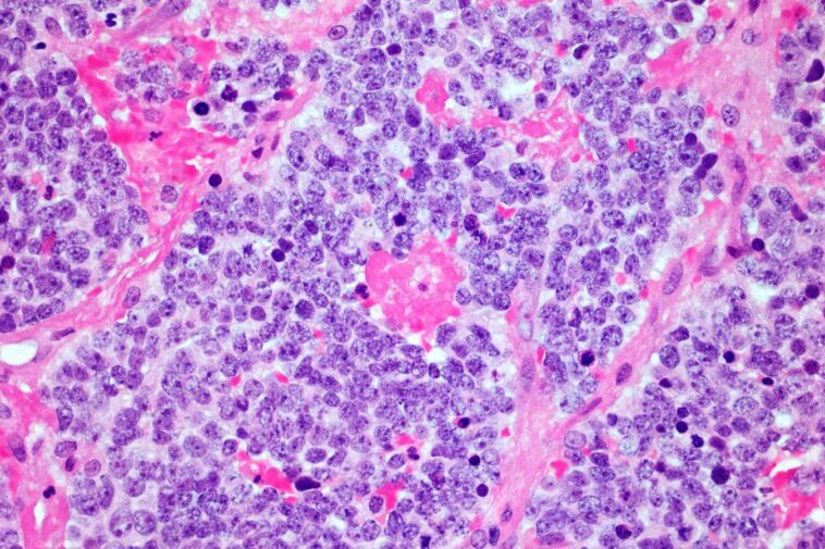 Les cellules en T voiture permettent une rémission record de cancer du nerf de 18 ans