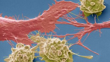 Colorectal cancer cells. Coloured scanning electron micrograph (SEM) of cancer cells from the human colon (large intestine). Cancer of the colon is also known as colorectal cancer. Symptoms include rectal bleeding and abdominal pain. Treatment is with surgery to remove the affected area. Colon cancer is one of the most common cancers in the Western world. Magnification: x 3000 when printed 10 centimetres wide.