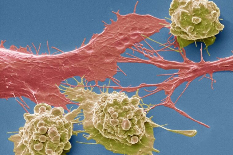 Colorectal cancer cells. Coloured scanning electron micrograph (SEM) of cancer cells from the human colon (large intestine). Cancer of the colon is also known as colorectal cancer. Symptoms include rectal bleeding and abdominal pain. Treatment is with surgery to remove the affected area. Colon cancer is one of the most common cancers in the Western world. Magnification: x 3000 when printed 10 centimetres wide.