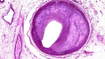 A light micrograph cross-section showing cholesterol-containing plaque in a heart artery