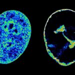 Human DNA in its natural state inside cells (left) compared to eight hours after being infected with the cold sore virus (right)