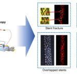 Imagerie de stent non invasive alimentée par la lumière et le son