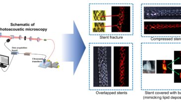 Imagerie de stent non invasive alimentée par la lumière et le son