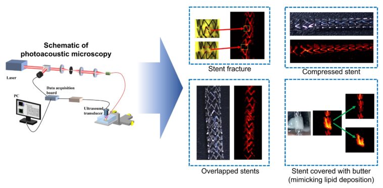 Imagerie de stent non invasive alimentée par la lumière et le son