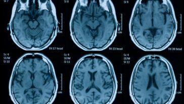 La pandémie a peut-être vieilli notre cerveau avant même que nous ayons pris Covid-19
