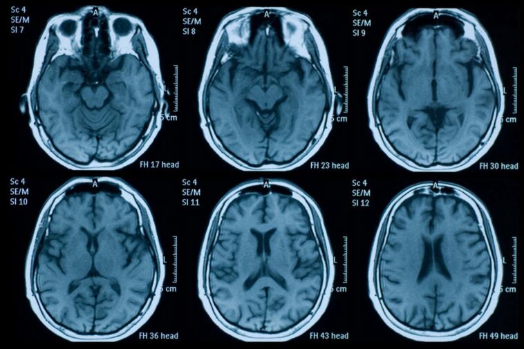 La pandémie a peut-être vieilli notre cerveau avant même que nous ayons pris Covid-19