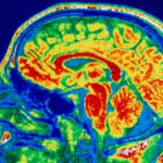 Le cerveau change avec les troubles de l'alimentation similaires à ceux du TOC et de l'autisme