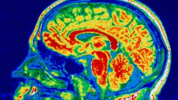 Le cerveau change avec les troubles de l'alimentation similaires à ceux du TOC et de l'autisme