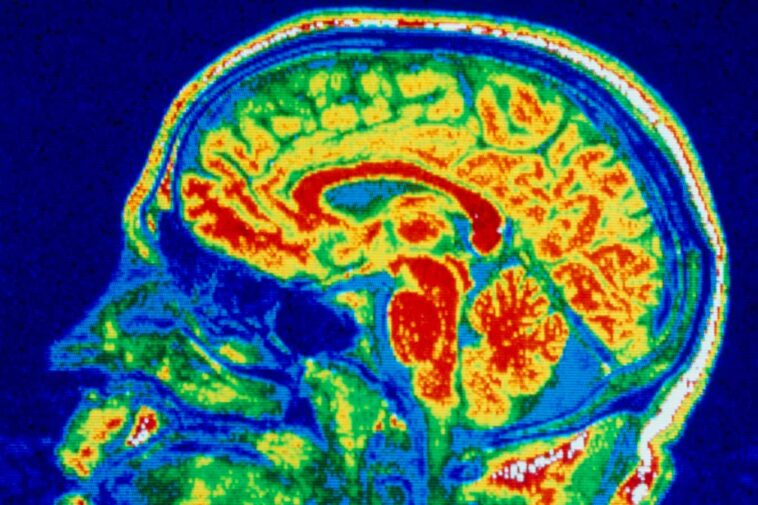 Le cerveau change avec les troubles de l'alimentation similaires à ceux du TOC et de l'autisme