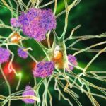 2G2HC45 Nerve cells affected by Alzheimer