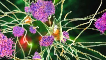 2G2HC45 Nerve cells affected by Alzheimer